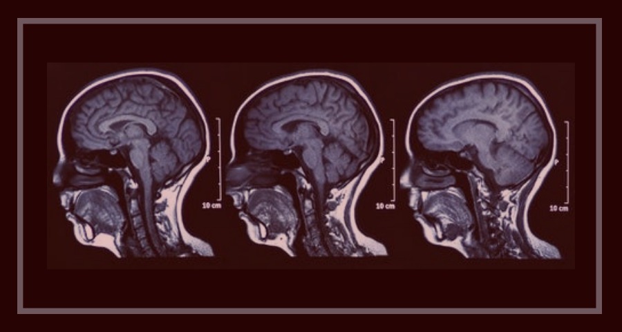 Em um fundo vermelho, o raio-x de 3 crânios
