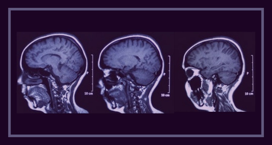 Em fundo roxo, imagem do raio-x de 3 crânios